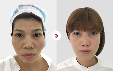 ảnh hạ gò má
