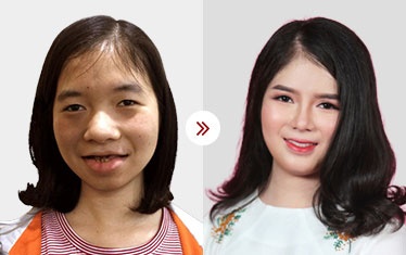 căng da trẻ hóa