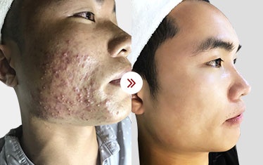 hình ảnh trị mụn