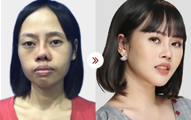 hình ảnh làm mũi