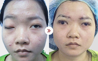 kh sửa mí