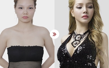 hình ảnh kq nâng ngực