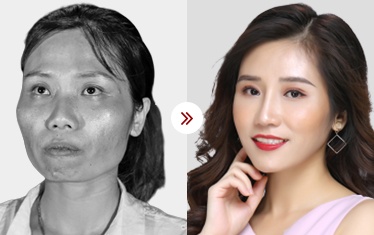 gọt mặt v-line 3d