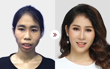 chỉnh sửa hàm hô