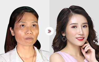 kết quả hạ gò má