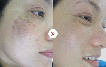 kết quả trị liệu da