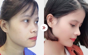 kết quả gọt hàm