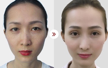 hình ảnh kh sửa mí