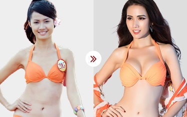 hình ảnh sau nâng ngực