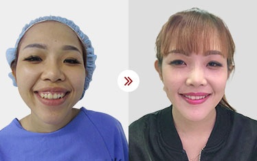 chỉnh sửa hàm hô móm