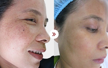hình ảnh sau điều trị da