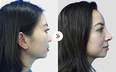 hình ảnh sau sữa mũi