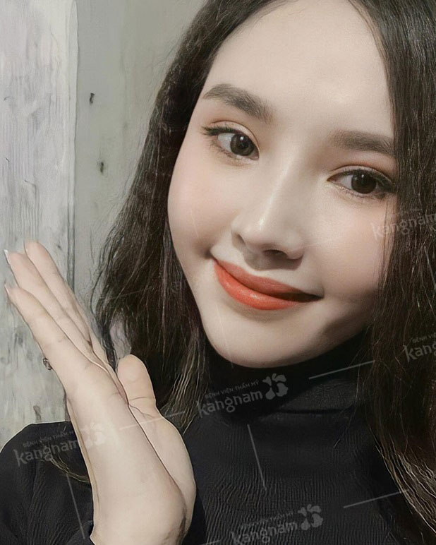 Đôi mắt biết cười của cô gái bấm mí Hàn Quốc đa điểm