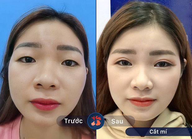 Kết quả trước và sau khi khách hàng cắt mí mắt 