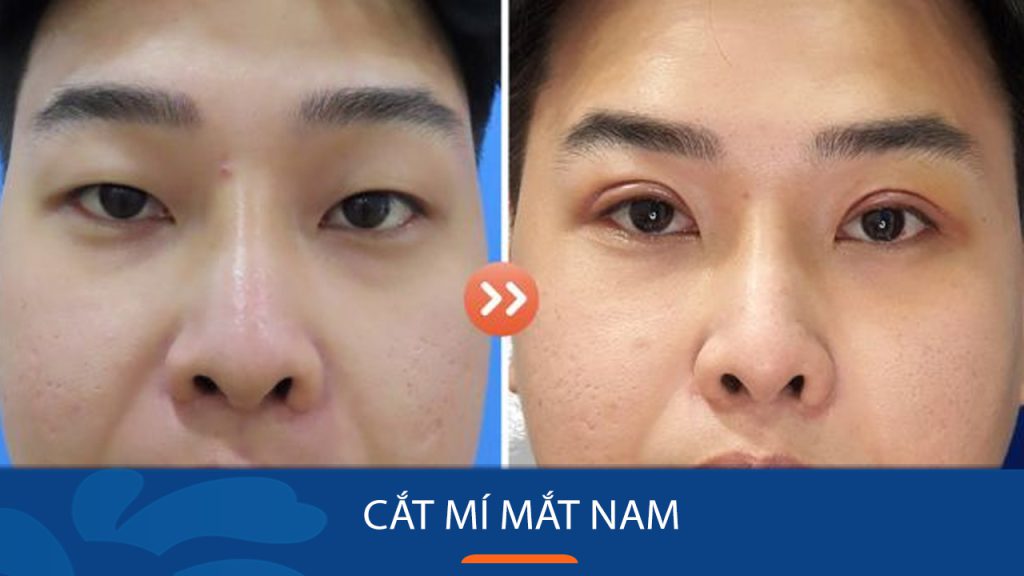 Cắt mí mắt cho nam giới có gì khác so với nữ giới? Giải đáp thắc mắc