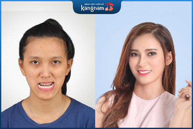 Sự khác biệt giữa trước và sau khi khách hàng chữa hàm móm tại Kangnam
