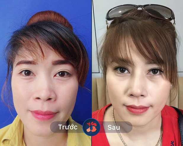 Trước: Mũi gãy đoạn, lệch sang bên phải - Sau: mũi được tái tạo: sống thẳng cao, đầu mũi thon nhỏ