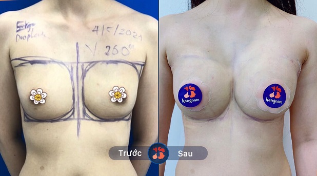 Kết quả thay đổi sau khi nâng ngực được 1 tháng