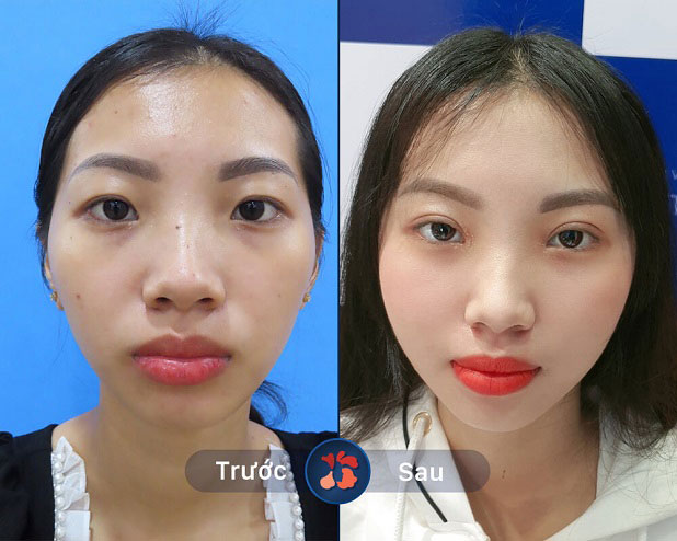 Mí đẹp tự nhiên như chưa từng qua phẫu thuật