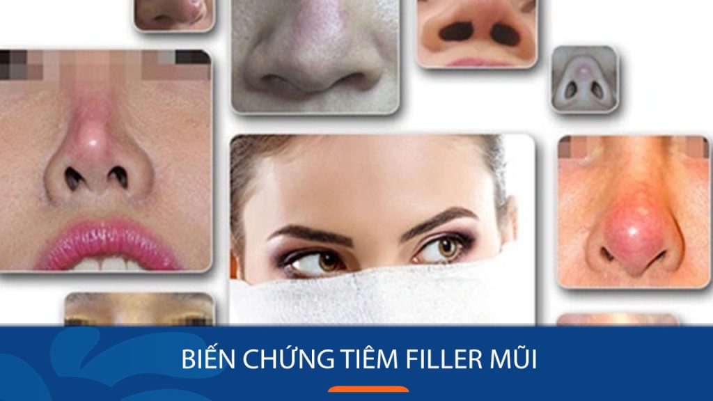5 Biến chứng Tiêm Filler Mũi nguy hiểm: Nên đọc để tránh