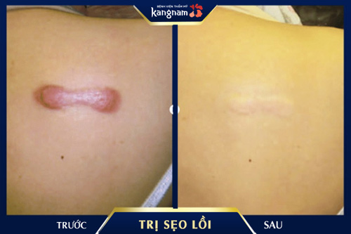 Vùng sẹo lồi sau phẫu thuật đã được cải thiện toàn diện bằng công nghệ ELLA độc quyền tại Kangnam