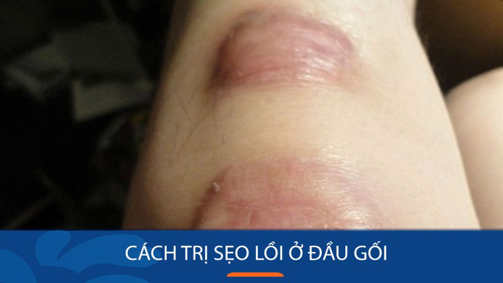 Cách trị sẹo lồi ở đầu gối: Loại bỏ sẹo lồi tận gốc với các phương pháp đơn giản tại nhà