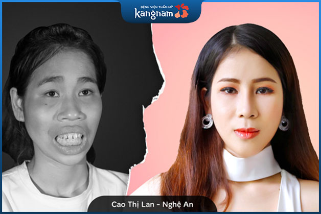 Cao Thị Lan trở nên nữ tính hơn sau khi chỉnh hình hàm mặt