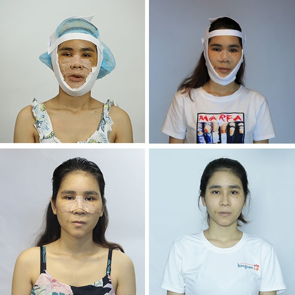 cắt hàm hô bao lâu thì lành