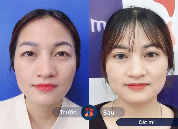 Kết quả trước và sau khi cắt mí 