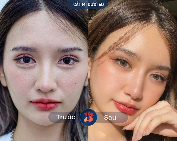 Trước và sau khi khách hàng cắt mí dưới 6D