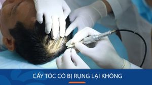 Cấy tóc có bị rụng lại không? Những lưu ý cần thiết khi cấy tóc