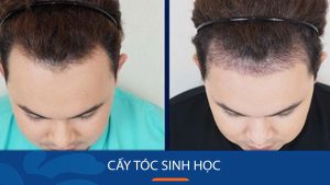 Cấy tóc sinh học là gì? Giữ được bao lâu? Giá bao nhiêu tiền?