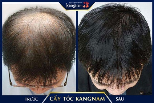 cấy tóc sinh học được bao lâu