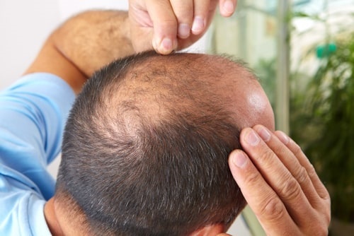 Cấy tóc tự thân tại Black Hair  giải pháp khắc phục hói đầu hiệu quả