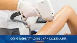 Công nghệ tẩy lông chân Diode Laser – sở hữu làn da sáng mịn