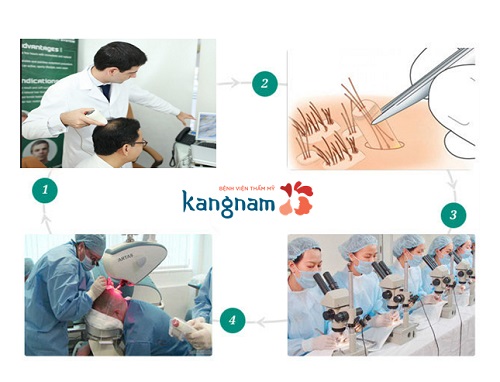 Quy trình cấy tóc đạt tiêu chuẩn tại BV Kangnam