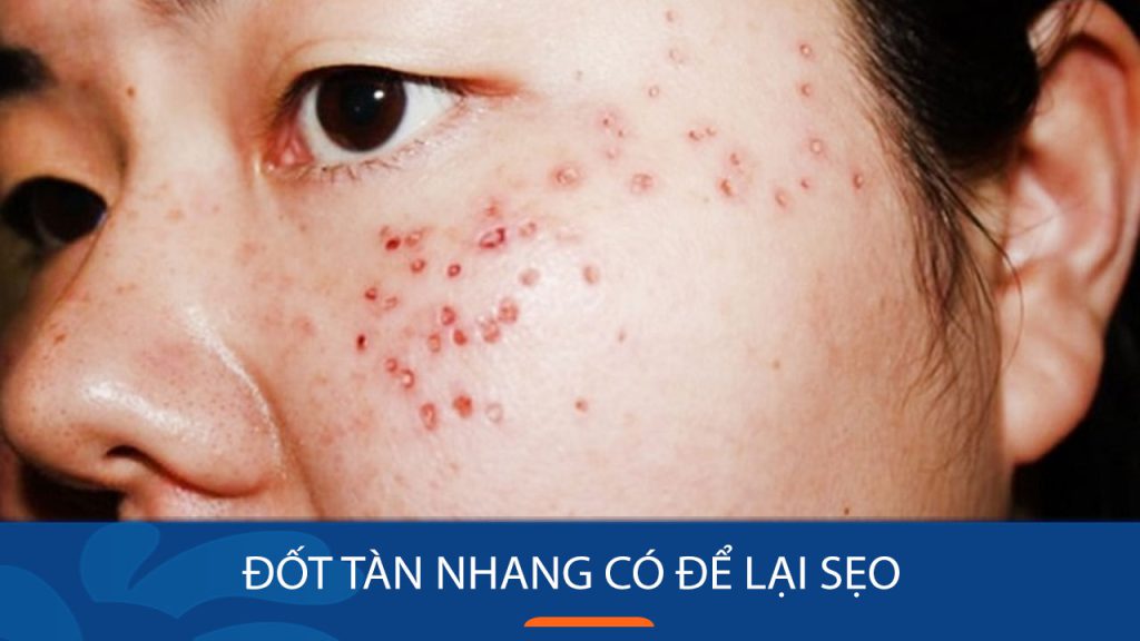 Bắn/đốt tàn nhang có để lại sẹo? Lưu ý phòng tránh sẹo