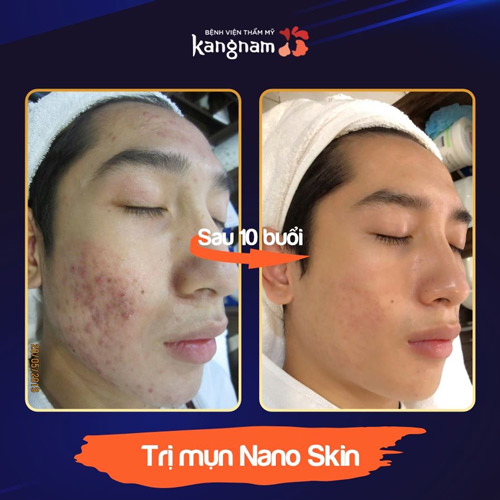 Khách hàng sau khi điều trị mụn tại Kangnam gương mặt đã trở nên mịn màng và đẹp hơn