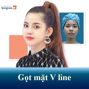Gọt mặt V line 3D Kangnam – Mặt thanh tú đẹp chuẩn Hàn