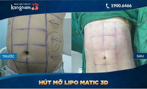 hút mỡ bụng có để lại di chứng