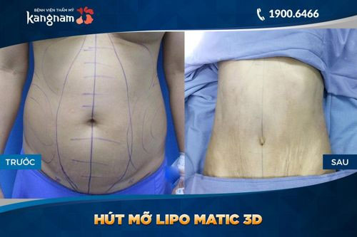 hút mỡ bụng giá bao nhiêu