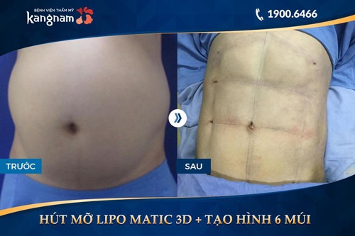 hút mỡ bụng nam