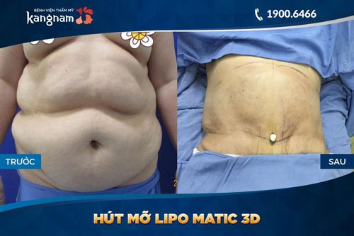 hút mỡ có ảnh hưởng về sau không