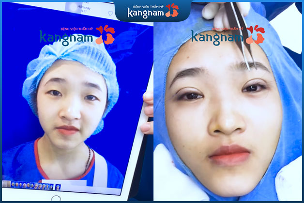 Kangnam hiện đang sở hữu công nghệ nhấn mí đẹp, thịnh hành