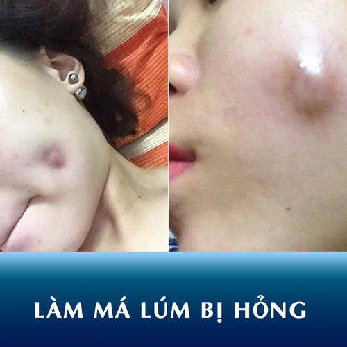 Làm má lúm bị Hỏng, Mưng Mủ- Nguyên Nhân và cách khắc phục