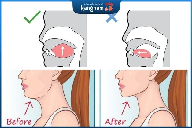 Khắc phục mặt lệch bằng phương pháp Mewing