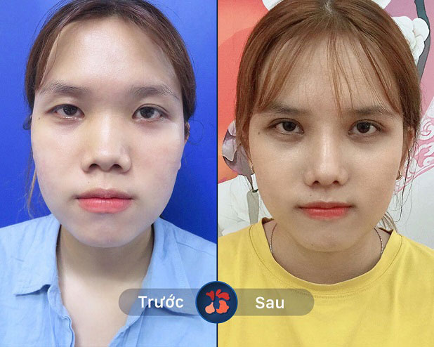 Khách hàng trước và sau khi nâng mũi tại Kangnam