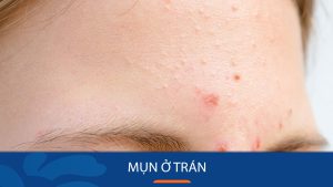 Cách trị mụn ở trán hiệu quả trong 7 ngày