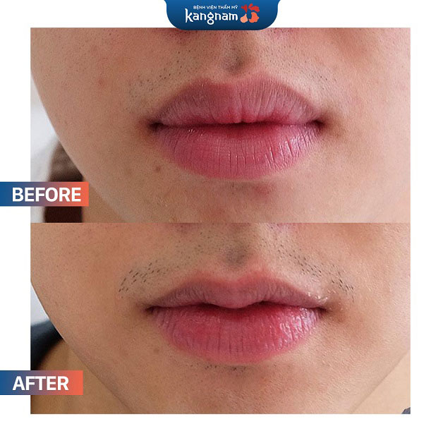 Trước và sau khi khách hàng thu gọn môi tại Kangnam