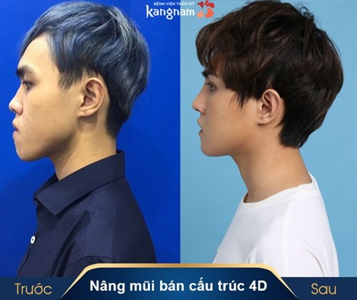 nâng mũi bán cấu trúc giá bao nhiêu